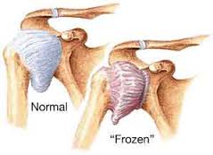 frozen shoulder, شانه یخ زده